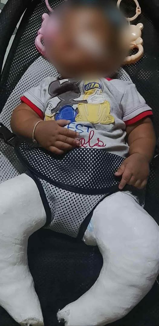 သံတွဲမြို့က လသားအရွယ် ကလေးငယ်တစ်ဦး ကော့စမွီဆေးရုံမှာဆေးကုသခံနေရပြီး အသက်ရှင်ရေး အတွက် အကူအညီလိုအပ်နေ